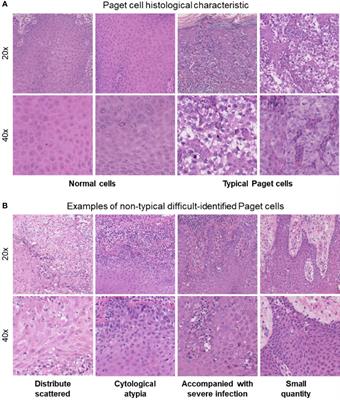 Development and Validation of an Artificial Intelligence-Based Image Classification Method for Pathological Diagnosis in Patients With Extramammary Paget’s Disease